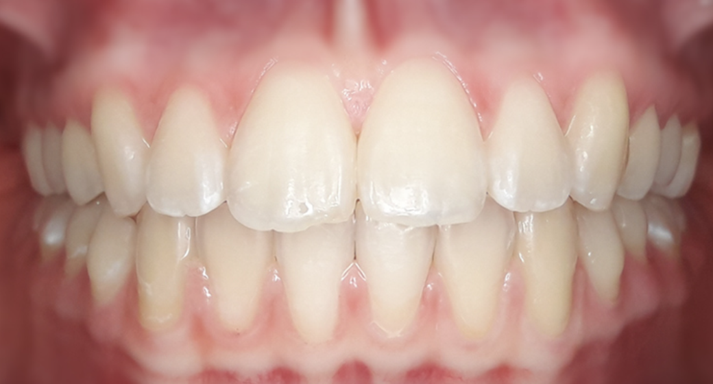 Behandlung Vorher-Nachher-Bild | Kieferorthopädie von Dr. med. dent. Neda Yavari | Elmshorn d82c8d16 Vorher-Bild