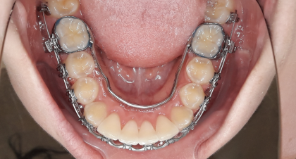 Vorher-Nachher-Bild | Kieferorthopädie  | von Dr.  Neda Yavari | Elmshorn d82c8d16 Nachher-Bild