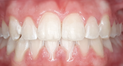 Vorher-Nachher-Bild | Kieferorthopädie von Dr. med. dent. Neda Yavari | Elmshorn d82c8d16 Nachher-Bild