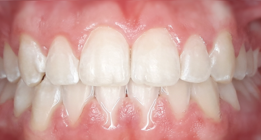 Behandlung Vorher-Nachher-Bild | Kieferorthopädie von Dr. med. dent. Neda Yavari | Elmshorn d82c8d16 Vorher-Bild