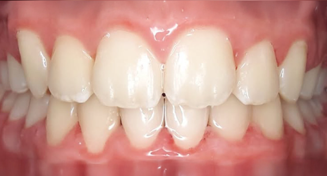 Behandlung Vorher-Nachher-Bild | Kieferorthopädie von    | Elmshorn d82c8d16 Vorher-Bild