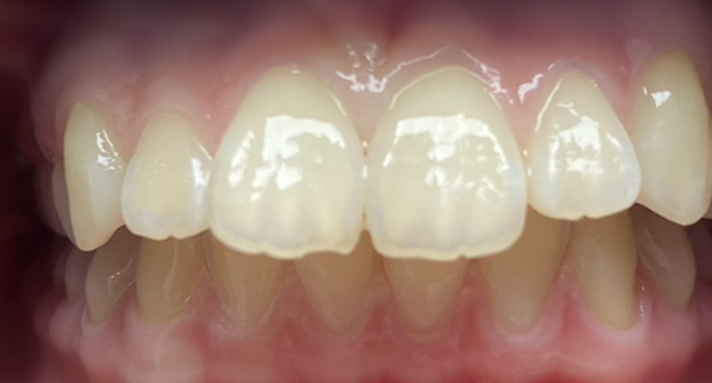 Behandlung Vorher-Nachher-Bild | Kieferorthopädie von Dr. med. dent. Neda Yavari | Elmshorn d82c8d16 Nachher-Bild