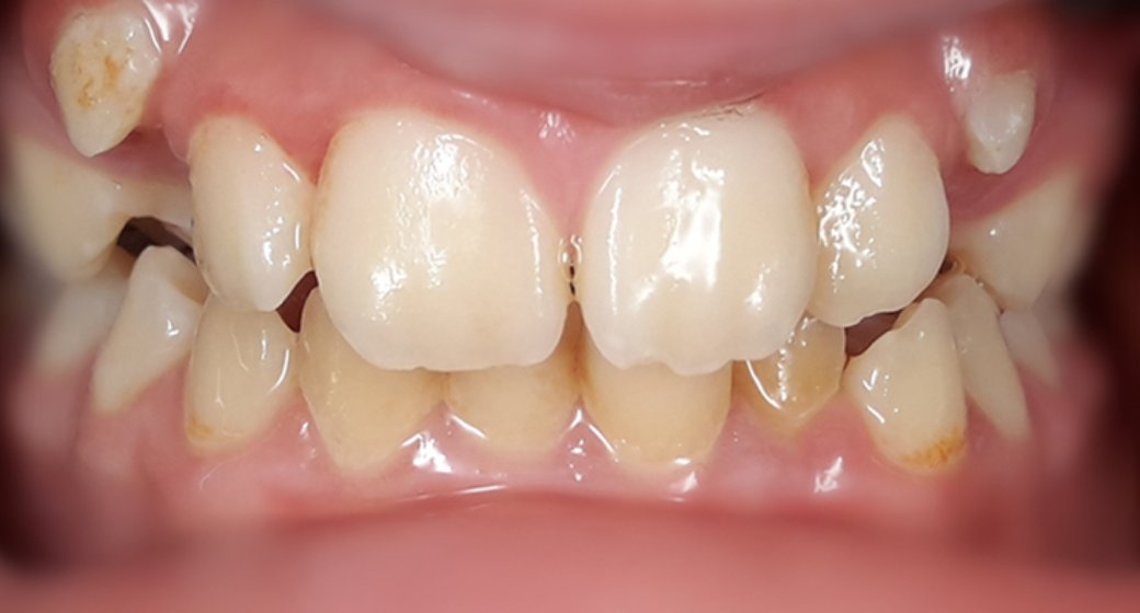 Behandlung Vorher-Nachher-Bild | Kieferorthopädie von    | Elmshorn d82c8d16 Nachher-Bild