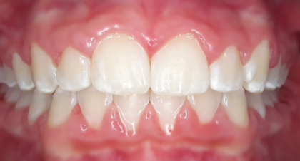 Vorher-Nachher-Bild | Kieferorthopädie von Dr. med. dent. Neda Yavari | Elmshorn d82c8d16 Nachher-Bild