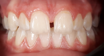 Vorher-Nachher-Bild | Kieferorthopädie von Dr. med. dent. Neda Yavari | Elmshorn d82c8d16 Vorher-Bild