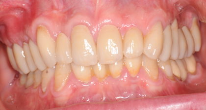 Vorher-Nachher-Bild von Dr. med. dent. Michael  Rak  | Bernried am Starnberger See d9d4f495 Nachher-Bild