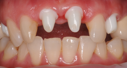 Vorher-Nachher-Bild | Implantate von Dr. med. dent. Gero Böthig | Bernried am Starnberger See d9d4f495 Vorher-Bild