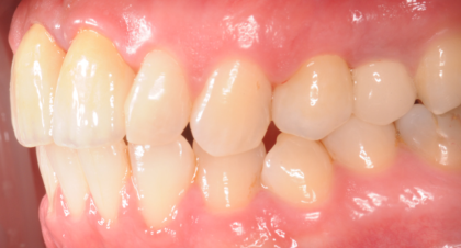 Vorher-Nachher-Bild | Implantate von Dr. med. dent. Gero Böthig | Bernried am Starnberger See d9d4f495 Nachher-Bild