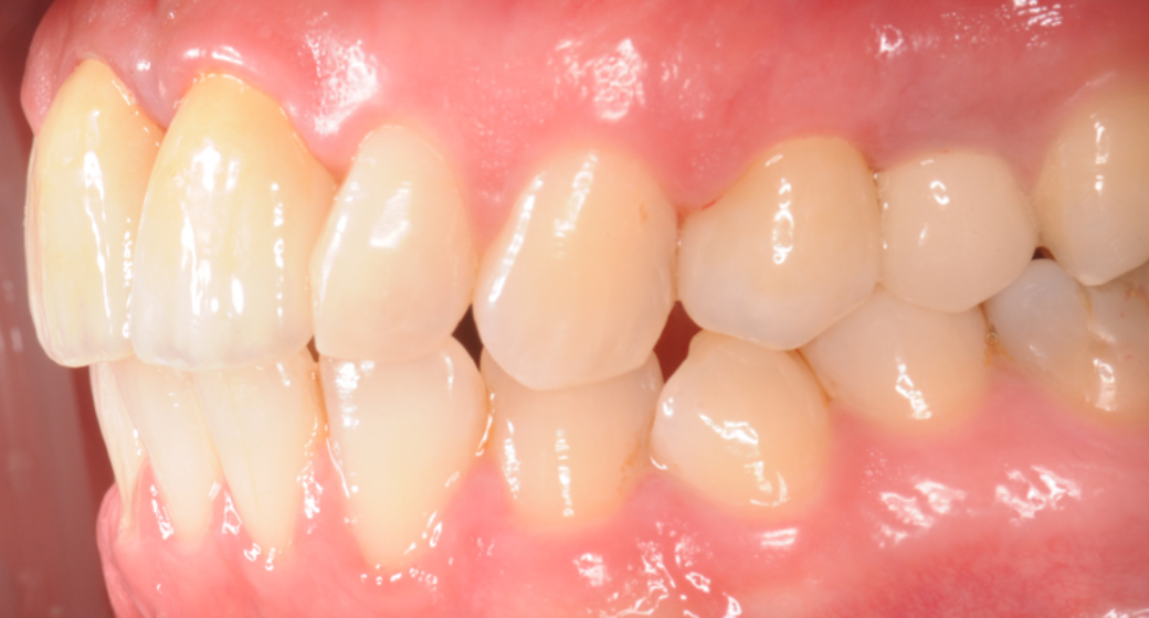 Behandlung Vorher-Nachher-Bild | Implantate von Dr. med. dent. Gero Böthig | Bernried am Starnberger See d9d4f495 Vorher-Bild