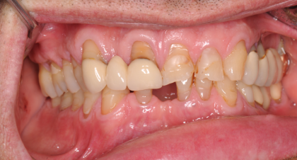 Vorher-Nachher-Bild | Kronen  | von Dr. med. dent. Michael  Rak  | Bernried am Starnberger See d9d4f495 Vorher-Bild