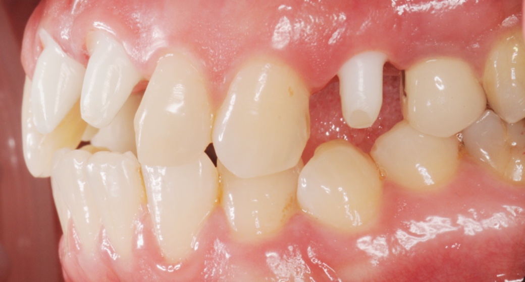 Behandlung Vorher-Nachher-Bild | Implantate von Dr. med. dent. Gero Böthig | Bernried am Starnberger See d9d4f495 Nachher-Bild