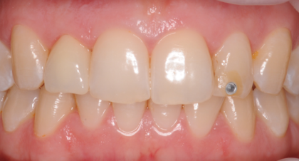 Vorher-Nachher-Bild | Implantate von Dr. med. dent. Gero Böthig | Bernried am Starnberger See d9d4f495 Nachher-Bild