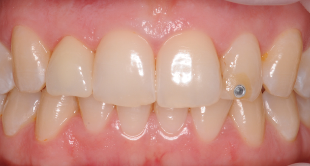 Behandlung Vorher-Nachher-Bild | Implantate von Dr. med. dent. Gero Böthig | Bernried am Starnberger See d9d4f495 Vorher-Bild