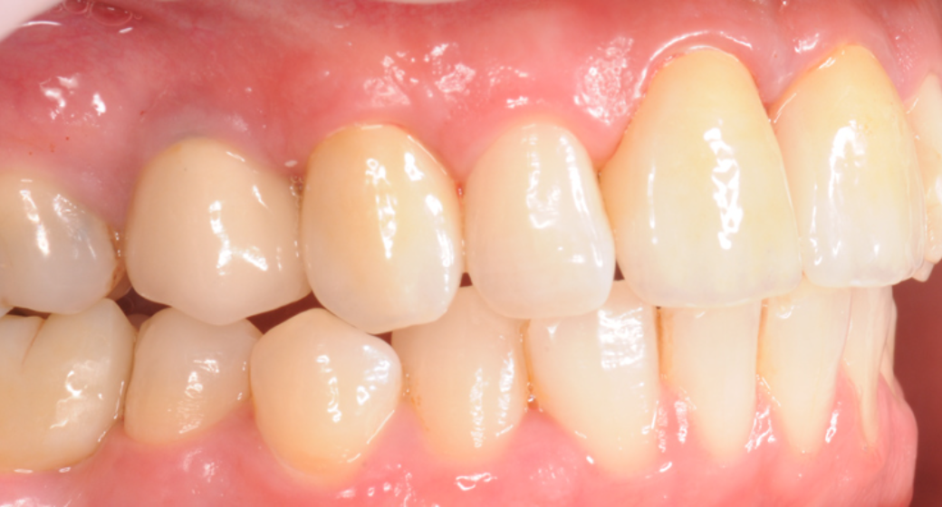 Behandlung Vorher-Nachher-Bild | Implantate von Dr. med. dent. Gero Böthig | Bernried am Starnberger See d9d4f495 Vorher-Bild