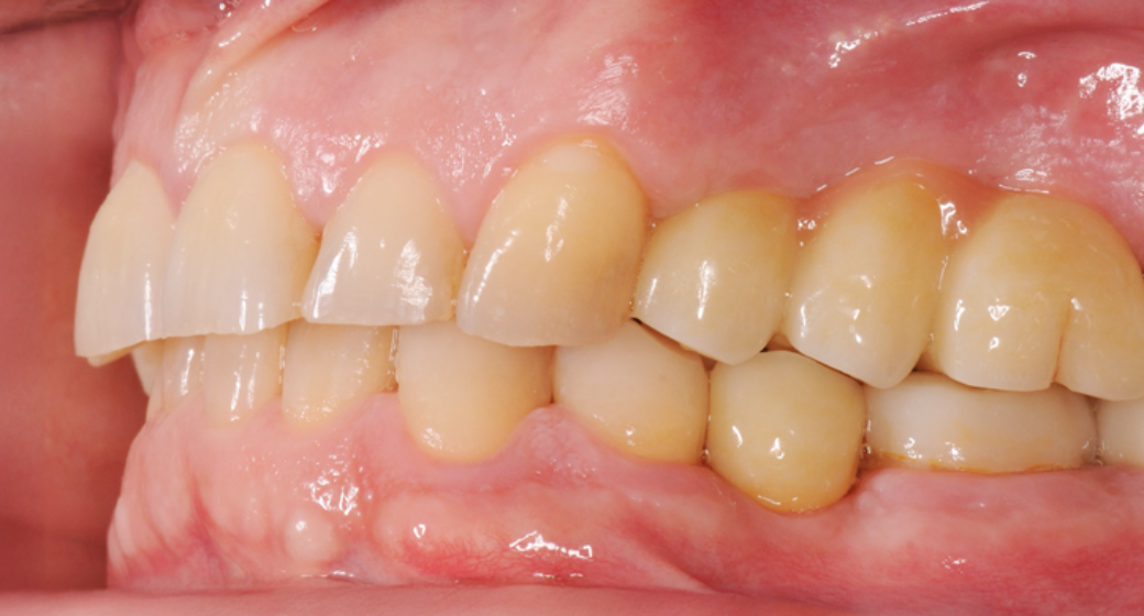 Behandlung Vorher-Nachher-Bild | Implantate von Dr. med. dent. Gero Böthig | Bernried am Starnberger See d9d4f495 Vorher-Bild