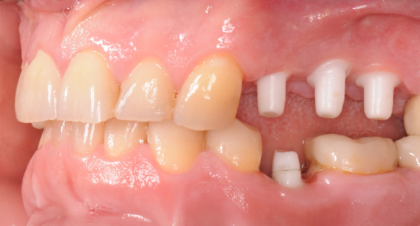 Vorher-Nachher-Bild | Implantate von Dr. med. dent. Gero Böthig | Bernried am Starnberger See d9d4f495 Vorher-Bild