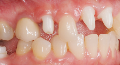 Vorher-Nachher-Bild | Implantate von Dr. med. dent. Gero Böthig | Bernried am Starnberger See d9d4f495 Vorher-Bild