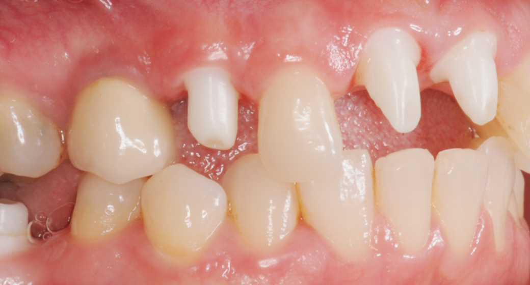 Behandlung Vorher-Nachher-Bild | Implantate von Dr. med. dent. Gero Böthig | Bernried am Starnberger See d9d4f495 Nachher-Bild