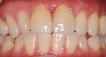 Vorher-Nachher-Bild | Implantate von Dr. med. dent. Gero Böthig | Bernried am Starnberger See d9d4f495 Nachher-Bild