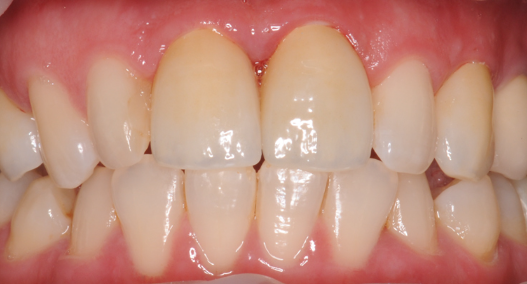 Behandlung Vorher-Nachher-Bild | Implantate von Dr. med. dent. Gero Böthig | Bernried am Starnberger See d9d4f495 Vorher-Bild