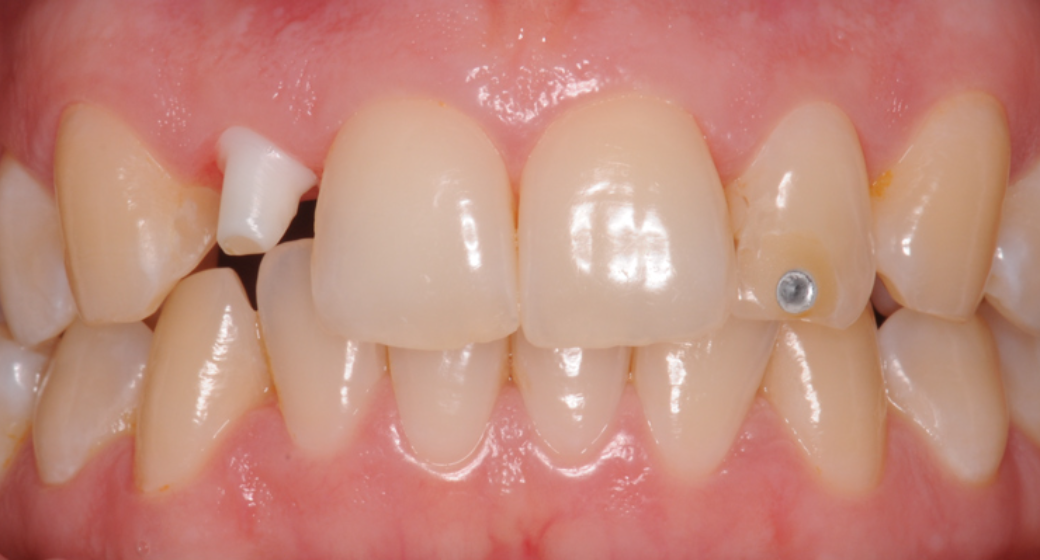 Behandlung Vorher-Nachher-Bild | Implantate von Dr. med. dent. Gero Böthig | Bernried am Starnberger See d9d4f495 Nachher-Bild