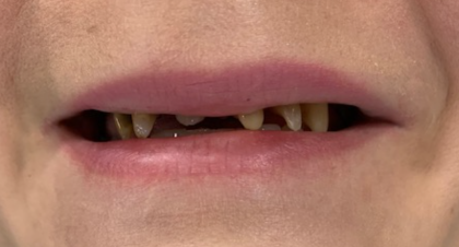 Vorher-Nachher | ZA Nasibeh  Rad Vorherbild