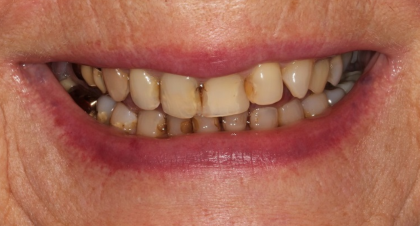 Vorher-Nachher-Bild | Kronen von  Anna Nasilowski | Bergisch Gladbach f770b62b Vorher-Bild