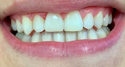 Vorher-Nachher-Bild | Füllung von  Anna Nasilowski | Bergisch Gladbach f770b62b Nachher-Bild