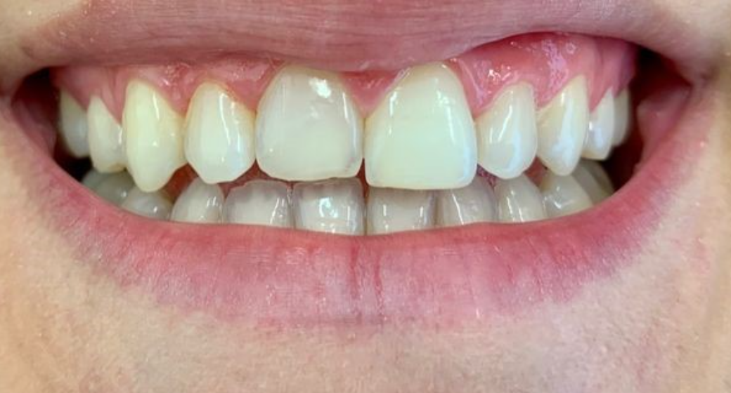 Behandlung Vorher-Nachher-Bild | Füllung von  Anna Nasilowski | Bergisch Gladbach f770b62b Nachher-Bild