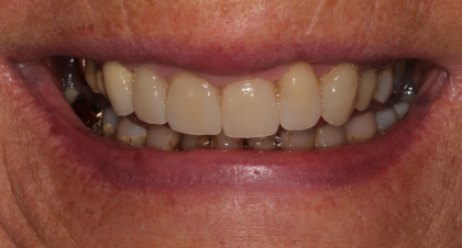 Vorher-Nachher-Bild | Kronen von  Anna Nasilowski | Bergisch Gladbach f770b62b Nachher-Bild