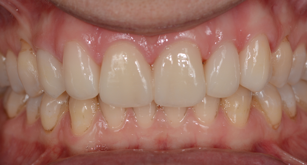 Behandlung Vorher-Nachher-Bild | Veneers von Dr. med. dent. Sabine Schindler | Sinzing fbd7939d Vorher-Bild